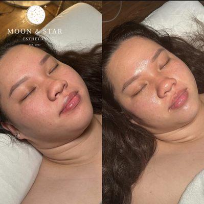 Before & After: Hydrating Facial