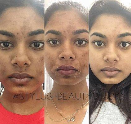 Process updated pictures of pharmaceutical chemical peel!