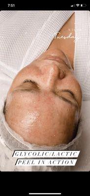 Chemical peel