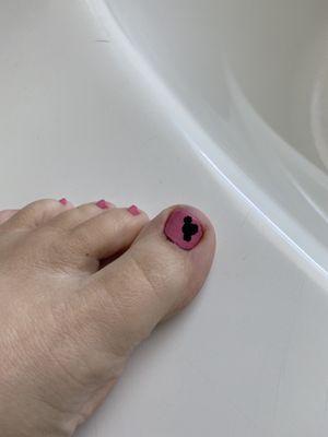 This is the "Mickey" they painted on my toe ‍‍