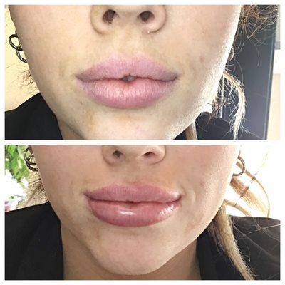 lip enhancement with correction of asymmetry