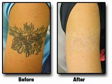 Tattoo Removal in Nashville, TN