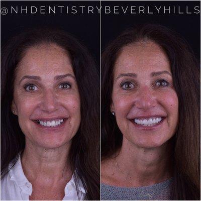 Crowns, Veneers and Implants