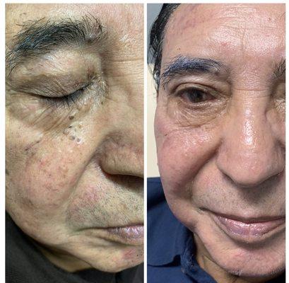 Before and after skin rejuvenation