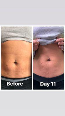 Fibroblast on stretch marks! No need for a tummy tuck to tighten loose skin