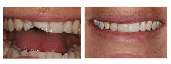 Oh no! Ashley chipped two of her teeth! Thankfully, Dr. Picot was able to restore her smile with two crowns.