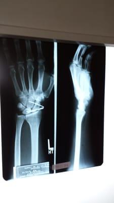 X-ray shows a successful orthopedic surgery.