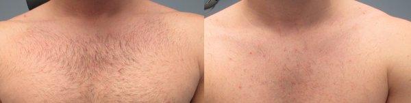 Laser Hair Removal Treatment Before & After  *Individual results may vary*