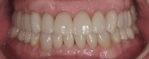 Customized layered porcelain crowns for a natural appearance