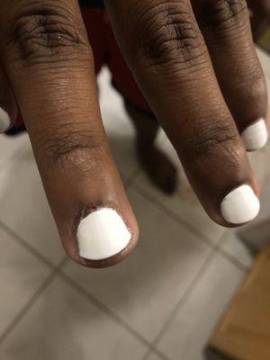 My brother's nails, bleeding along the cuticle