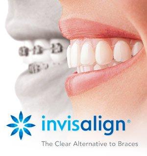 The invisible way to straighten your teeth without braces.