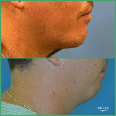 Chin implant