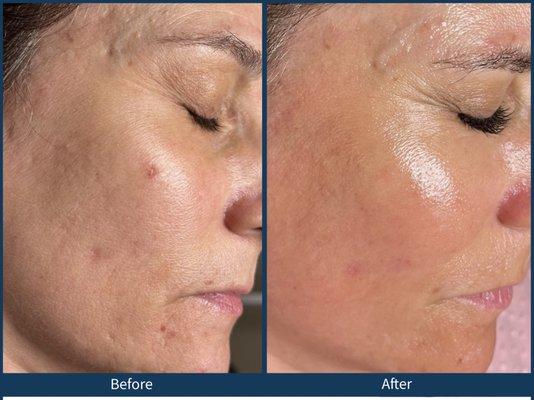 Beautiful results after Microneedling