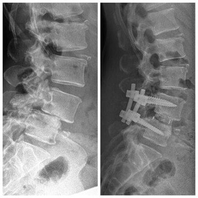 Degenerative spondylolisthesis