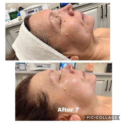 TAMA microcurrent treatment Age reverse results