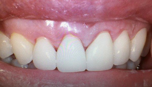 My beautiful Veneers I had mention in my review.