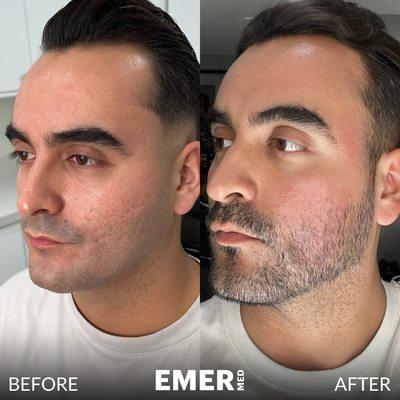 Our patient struggled with acne scars for many years. He came to us for a combo treatment to achieve smooth and even skin