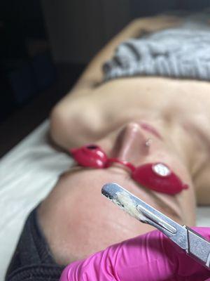 Dermaplaning