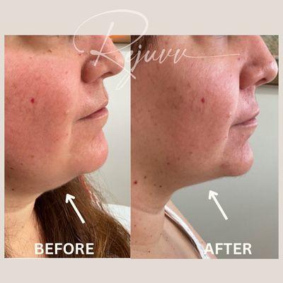 Liquid lipo for double chin $299 per session