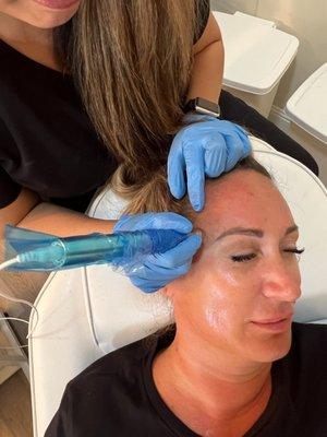 Microneedling