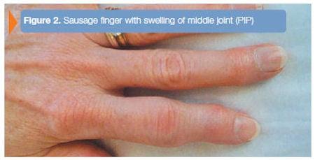 Psoriatic Arthritis of the Hand - Dallas/Ft Worth Hand Surgeon