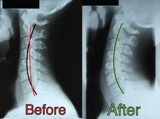 Real results of Terry Chiropractic. For more before and afters as well as testimonials visit our website!