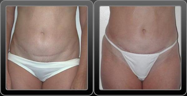 Abdominoplasty Before & After