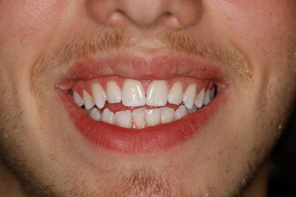 Invisalign Before