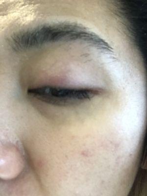 Infection from eyelash extension