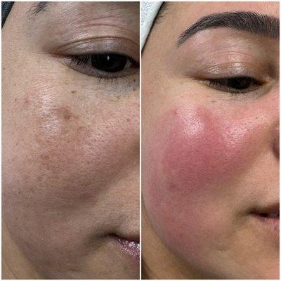 Melasma and Dark spot Treatment