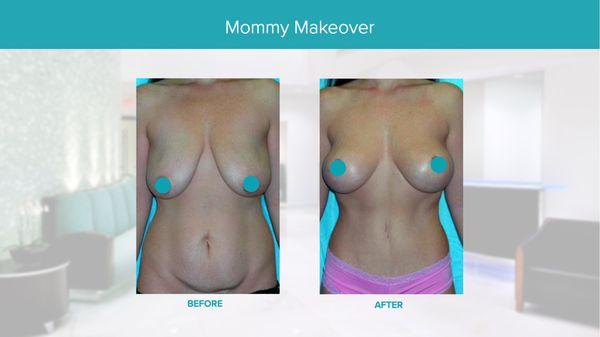 Real Results Before & After-Mommy Makeover