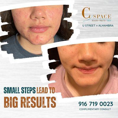 We specialize in acne treatments! Let us help you find what works.