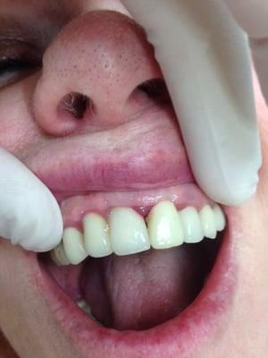 Case #4: Immediate implant placement and restoration of an upper central incisor