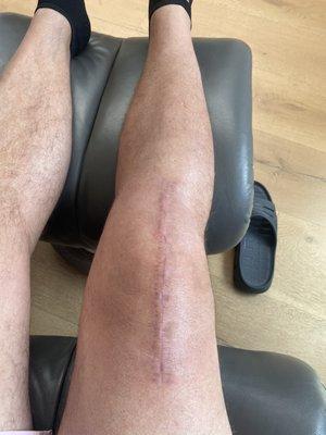 6 weeks after surgery. Knee feels strong and solid. Thank you Dr. Klapper!