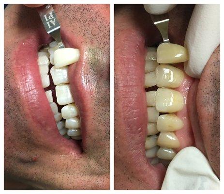 Before and After ZOOM whitening