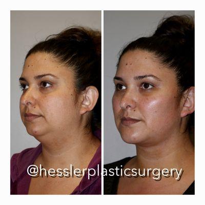 This patient underwent minimally invasive procedures including buccal fat removal, facetite, ultherapy and fat transfer to the face.