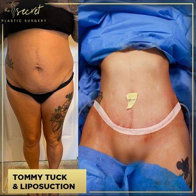 Liposuction Miami - The Secret Plastic Surgery