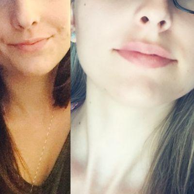 Lip augmentation. Natural Results. Actual client.