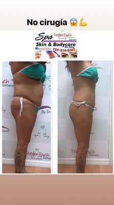 body shaping  No surgery