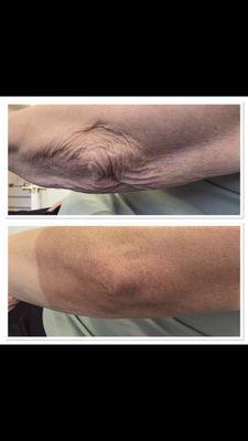 Arm Plasma Fibroblast Skin Tightening