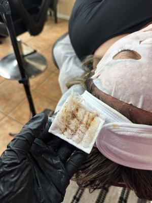 dermaplaning