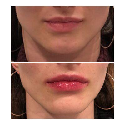 Before and after #lipfiller