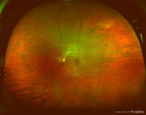 Wide angle retinal scan known as Optomap - Included at no extra cost for all NEW patients.