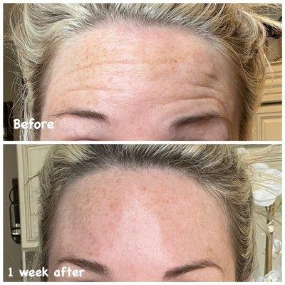 Dysport brand botox results.