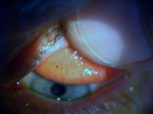 Conjunctival foreign body