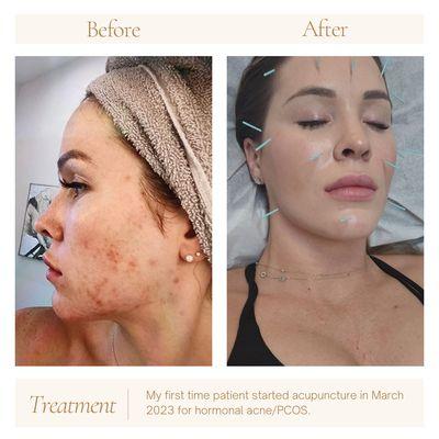 Before/After Facial Needling