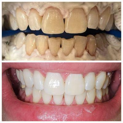 Zoom Whitening.. Amazing Results!