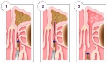 Balloon Sinuplasty http://www.otolaryngology-assoc.com/our_services/balloon_sinuplasty.aspx