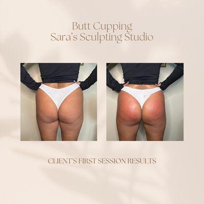 Butt cupping