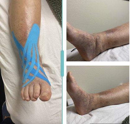 Lymphedema